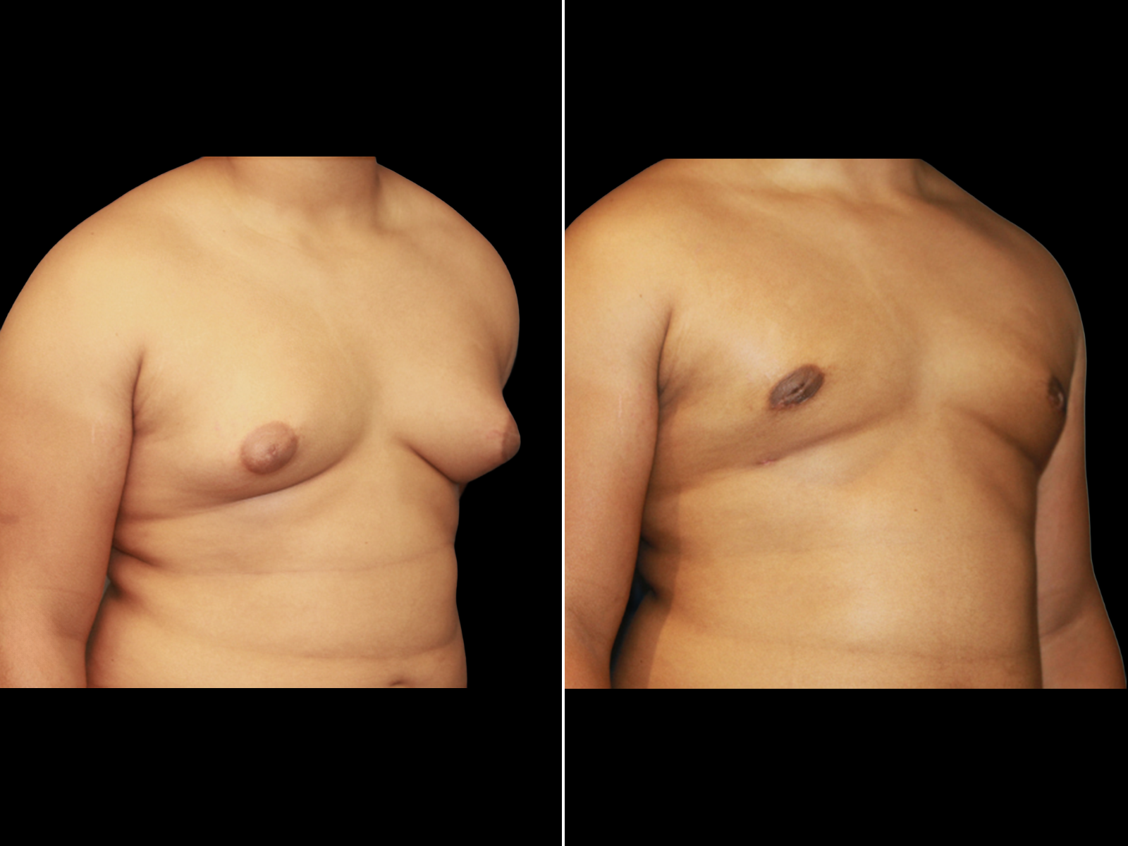 Gynecomastia D2