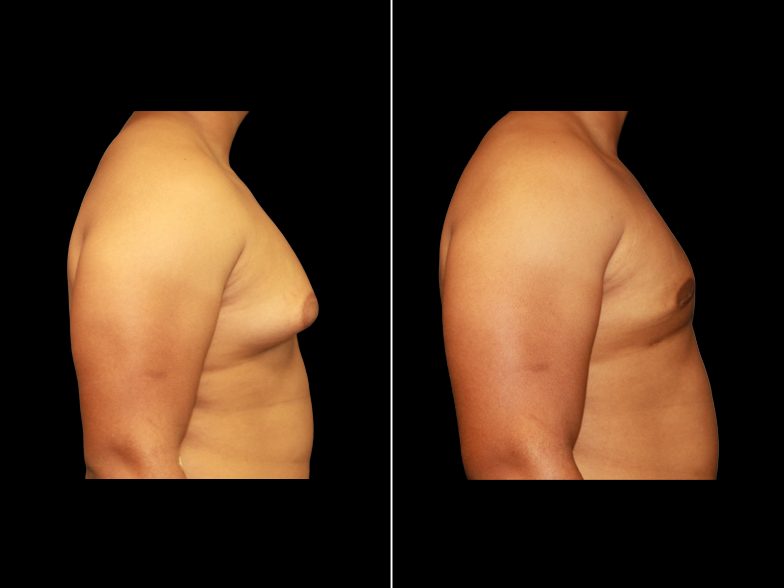 Gynecomastia D3