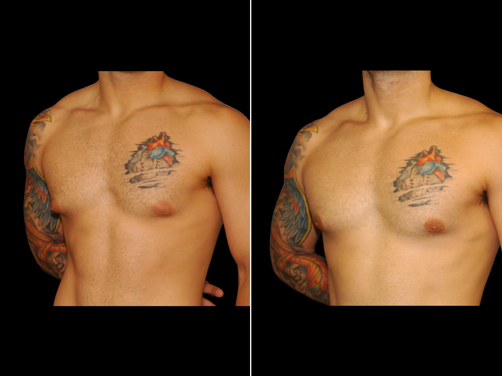 Gynecomastia E2