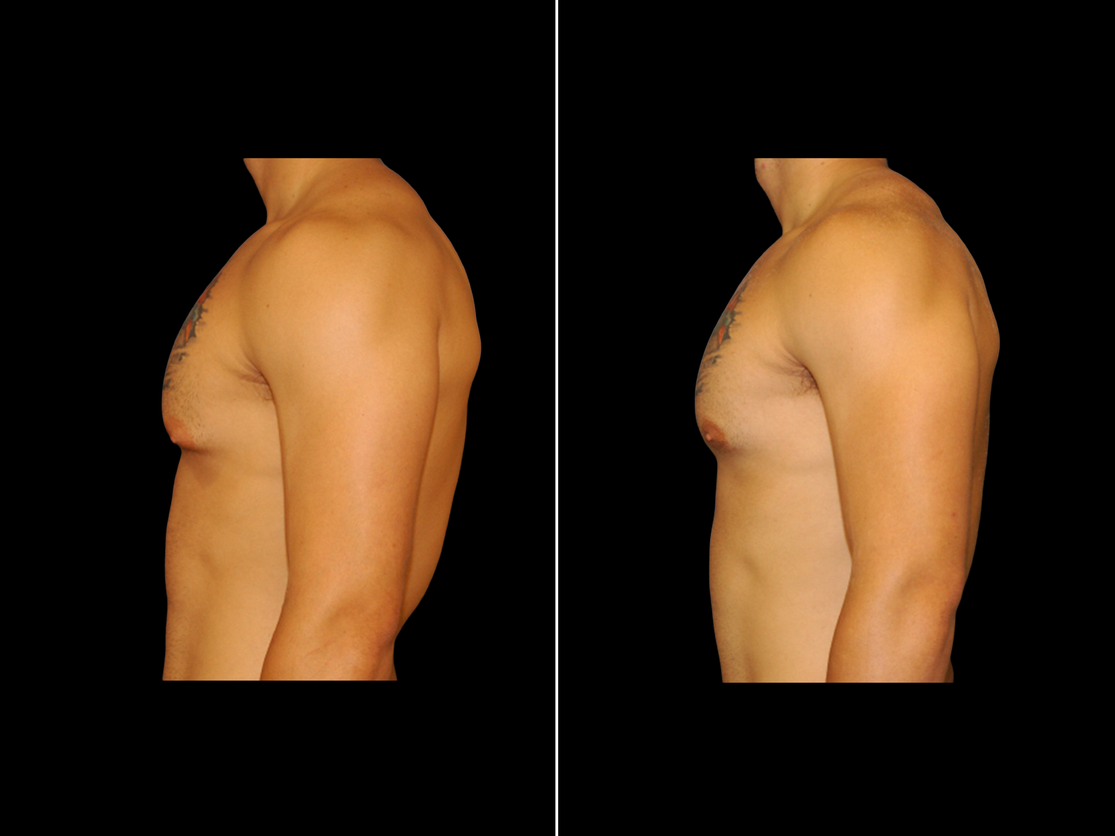 Gynecomastia E3