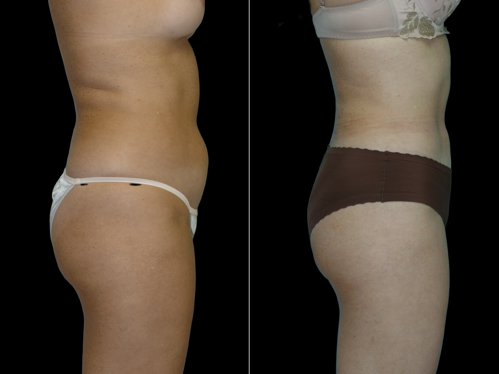 Liposuction C3