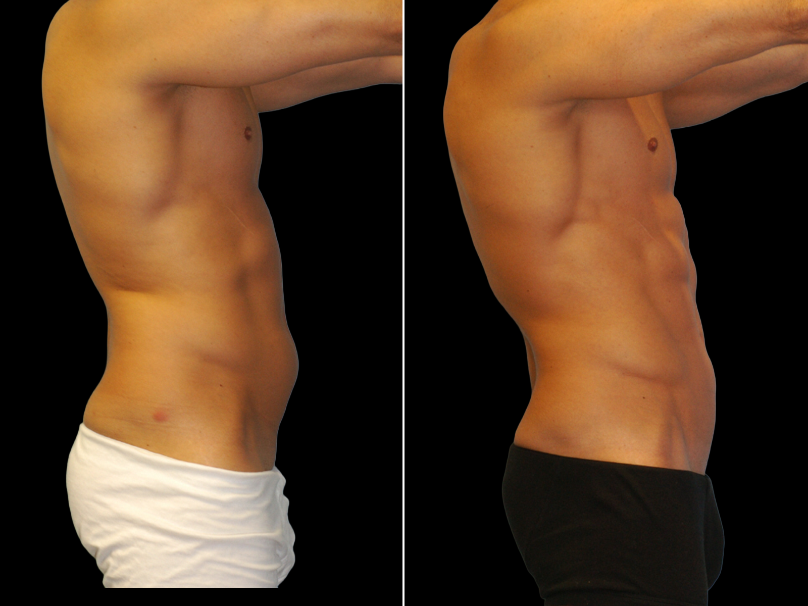 Liposuction D2