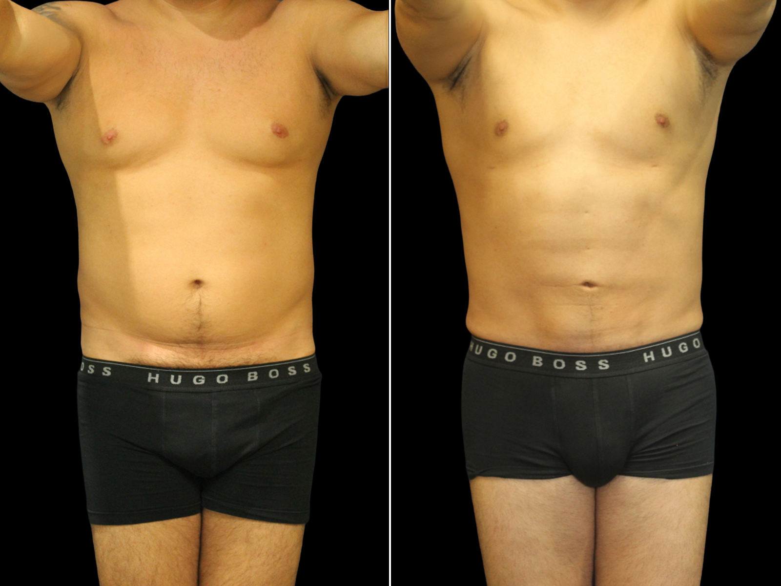 Liposuction E1