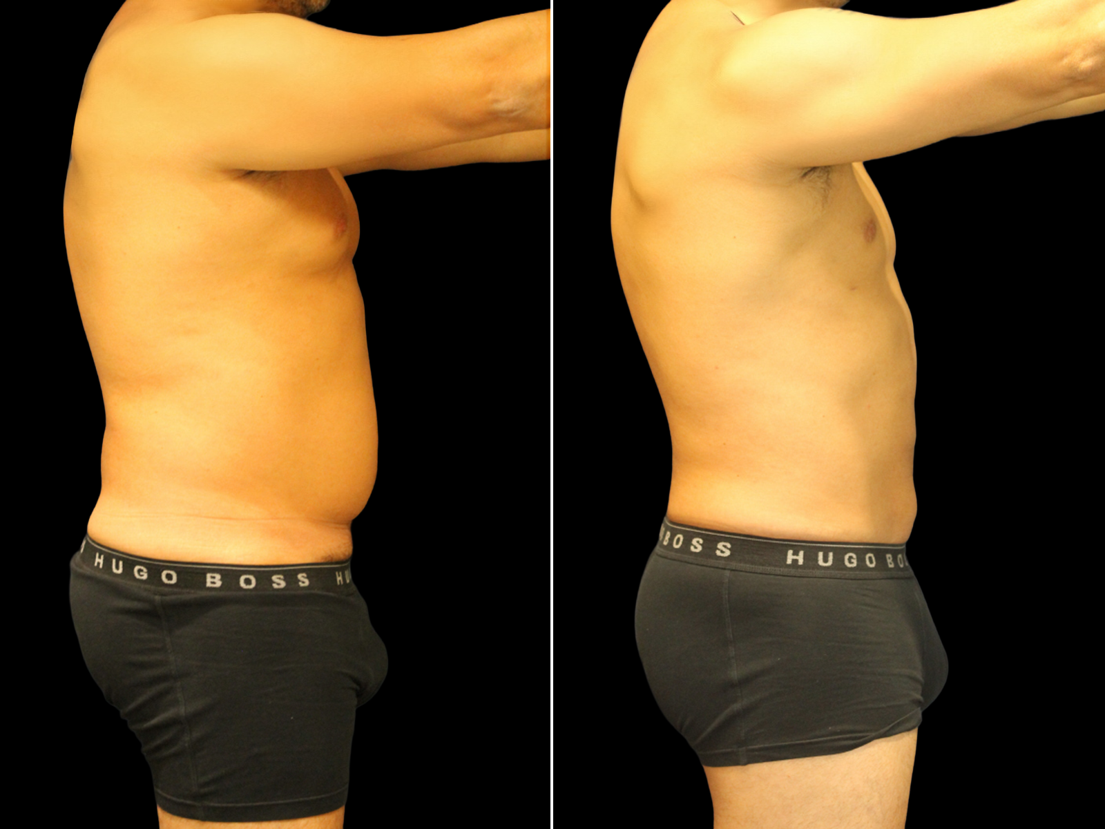Liposuction E2