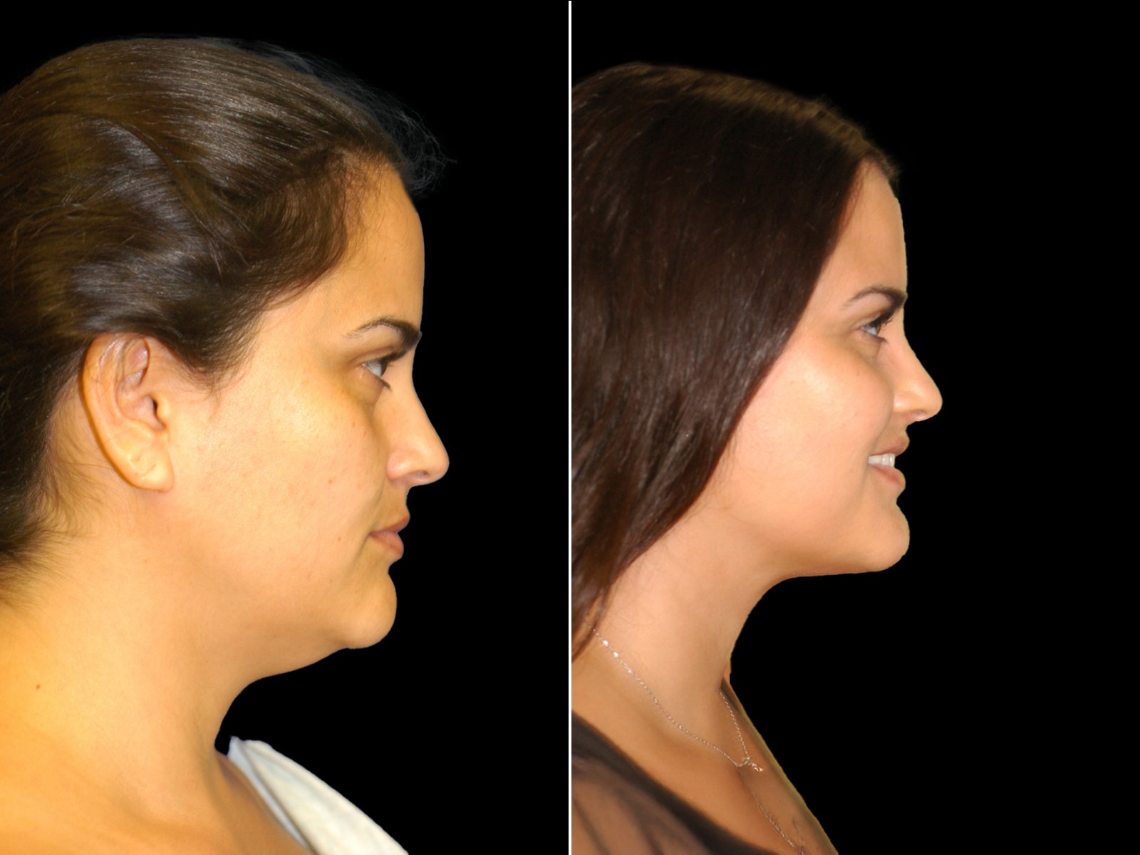 chin-liposuction-before-and-after-dr-soler-baillo-coral-gables-01
