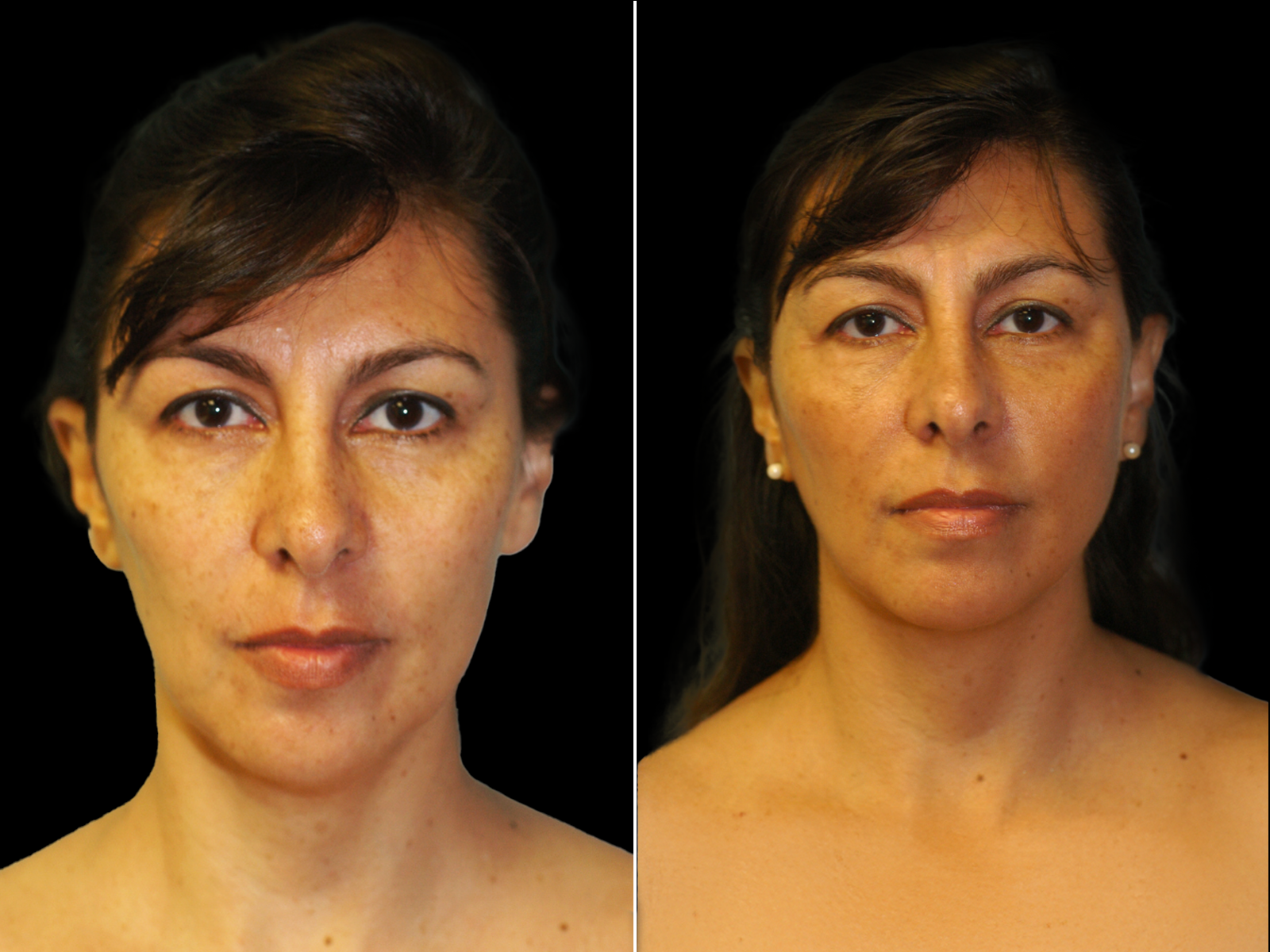 chin-liposuction-before-and-after-dr-soler-baillo-coral-gables-02