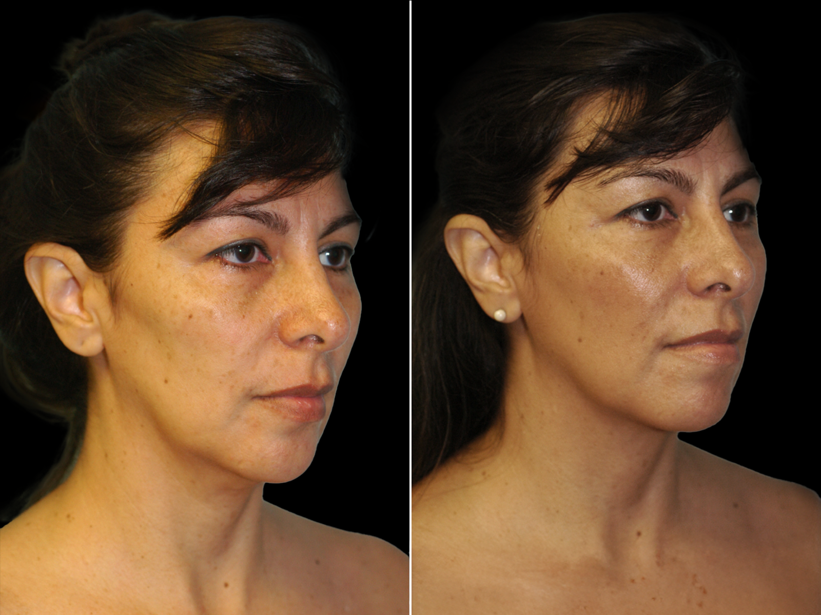 chin-liposuction-before-and-after-dr-soler-baillo-coral-gables-03