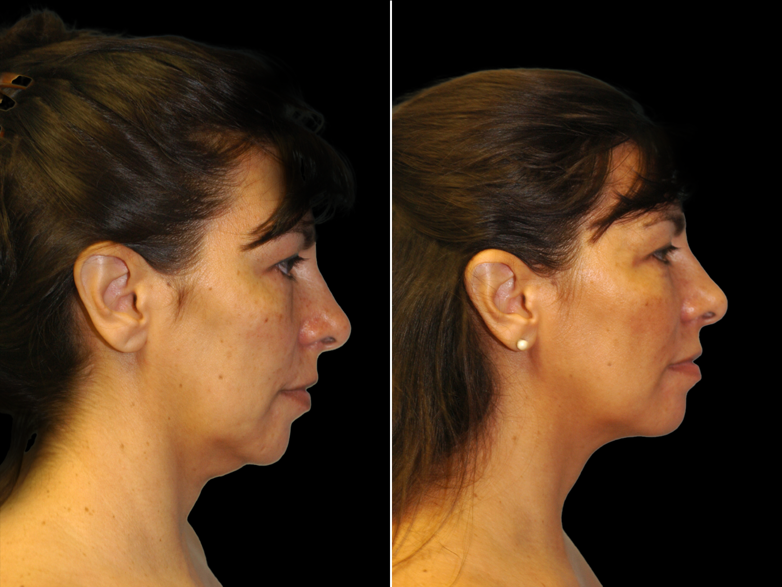 chin-liposuction-before-and-after-dr-soler-baillo-coral-gables-04