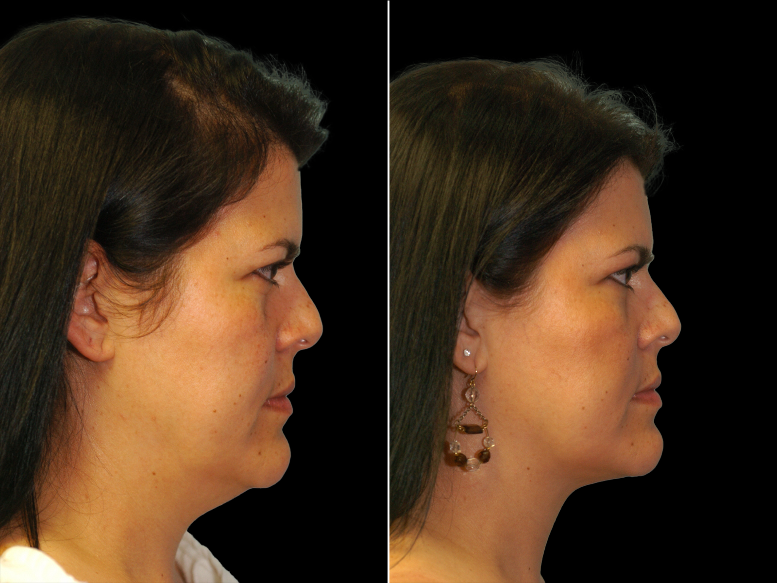 chin-liposuction-before-and-after-dr-soler-baillo-coral-gables-05