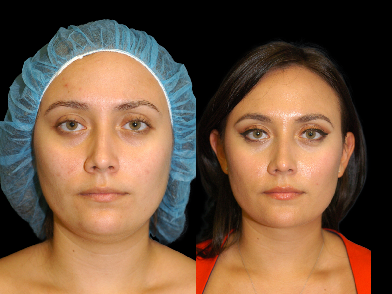 chin-liposuction-before-and-after-dr-soler-baillo-coral-gables-06
