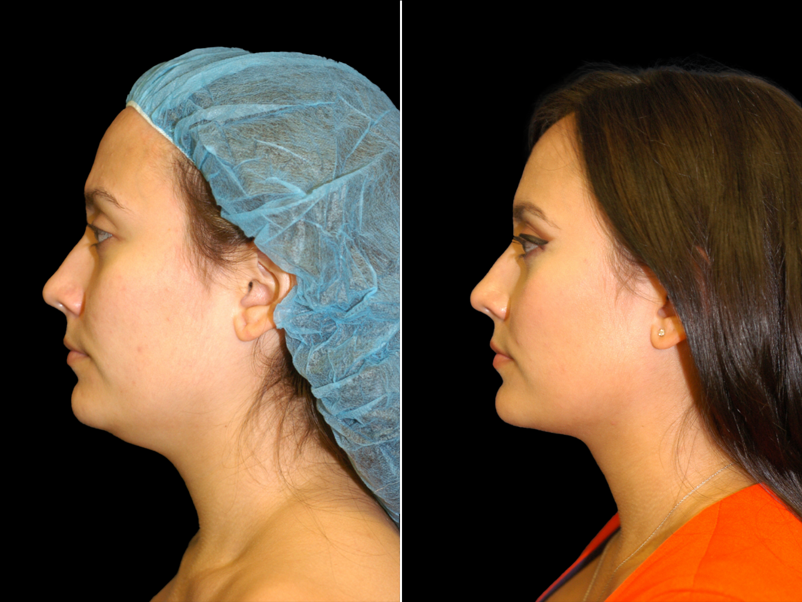 chin-liposuction-before-and-after-dr-soler-baillo-coral-gables-07