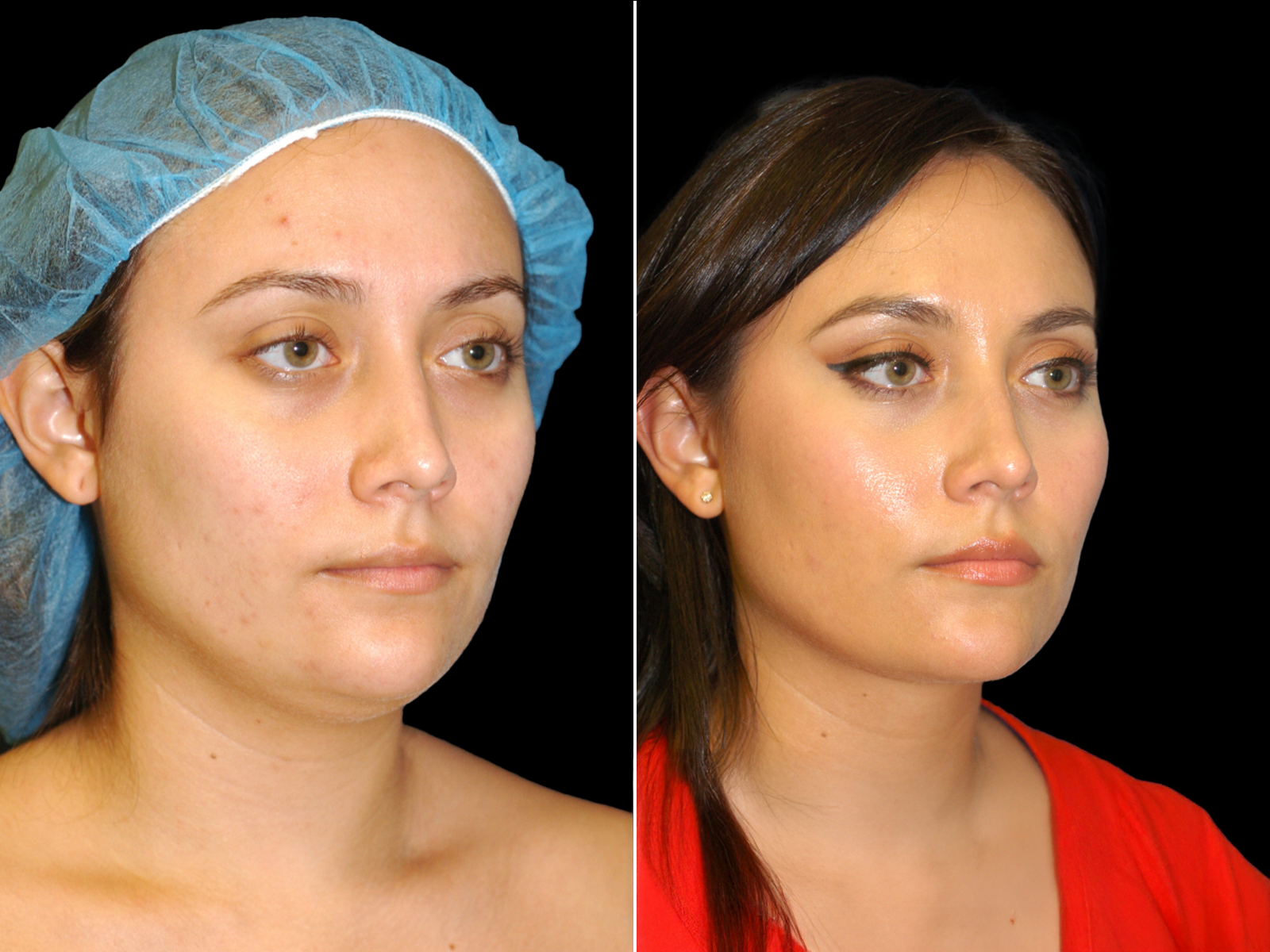 chin-liposuction-before-and-after-dr-soler-baillo-coral-gables-08