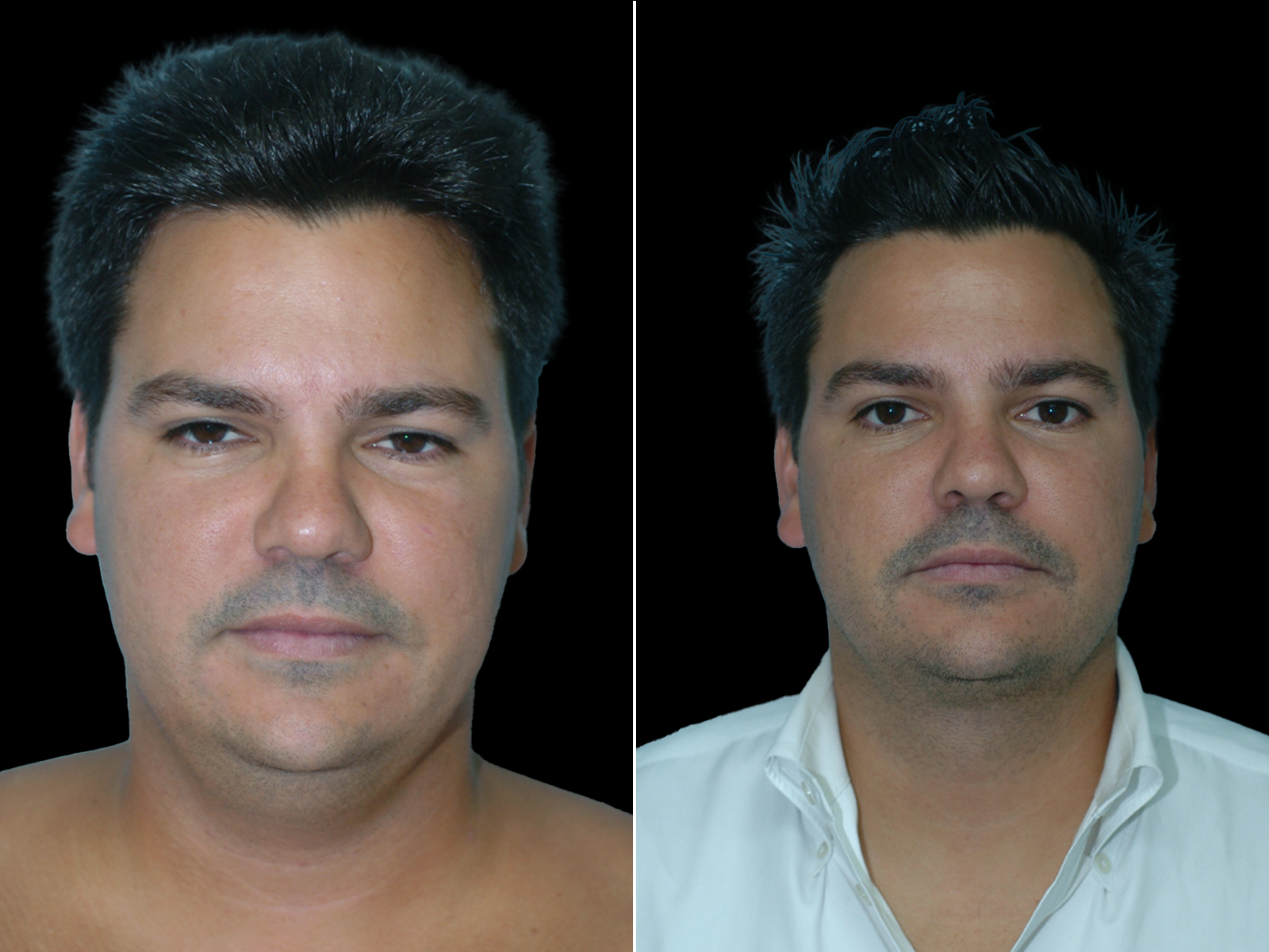 chin-liposuction-before-and-after-dr-soler-baillo-coral-gables-09