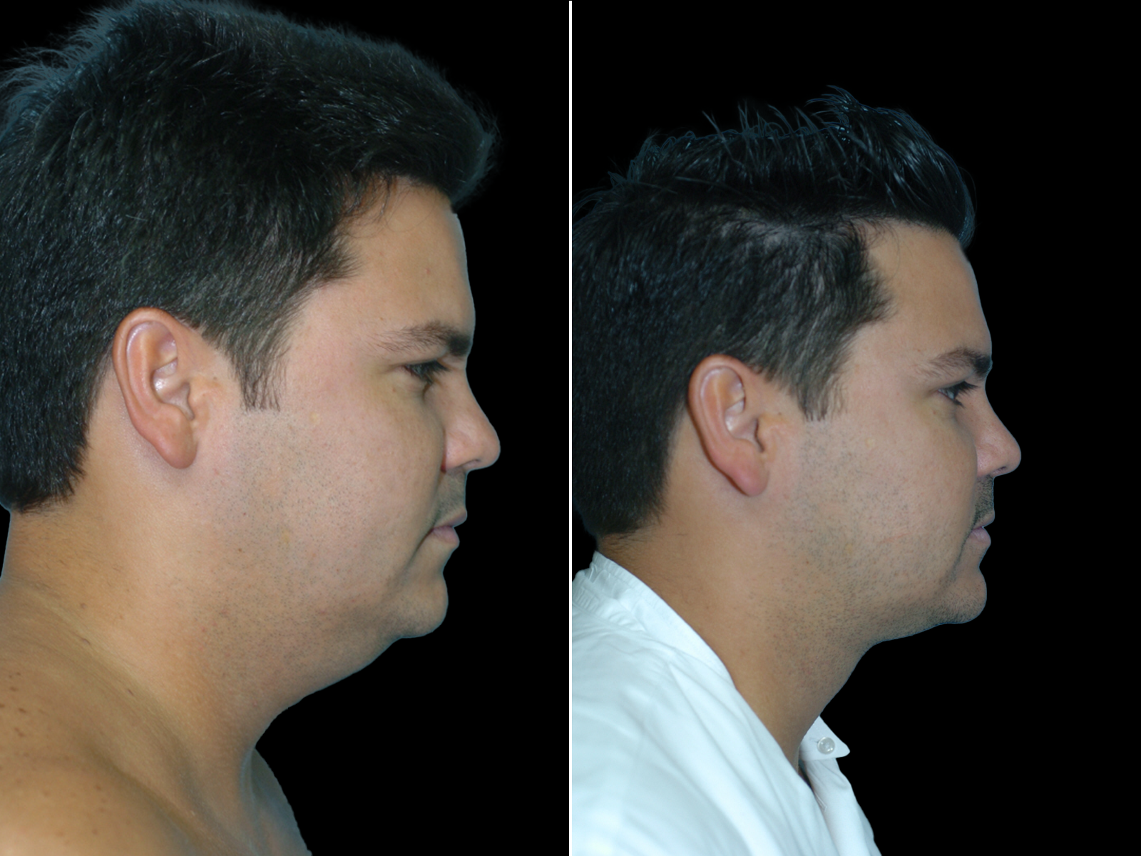 chin-liposuction-before-and-after-dr-soler-baillo-coral-gables-10