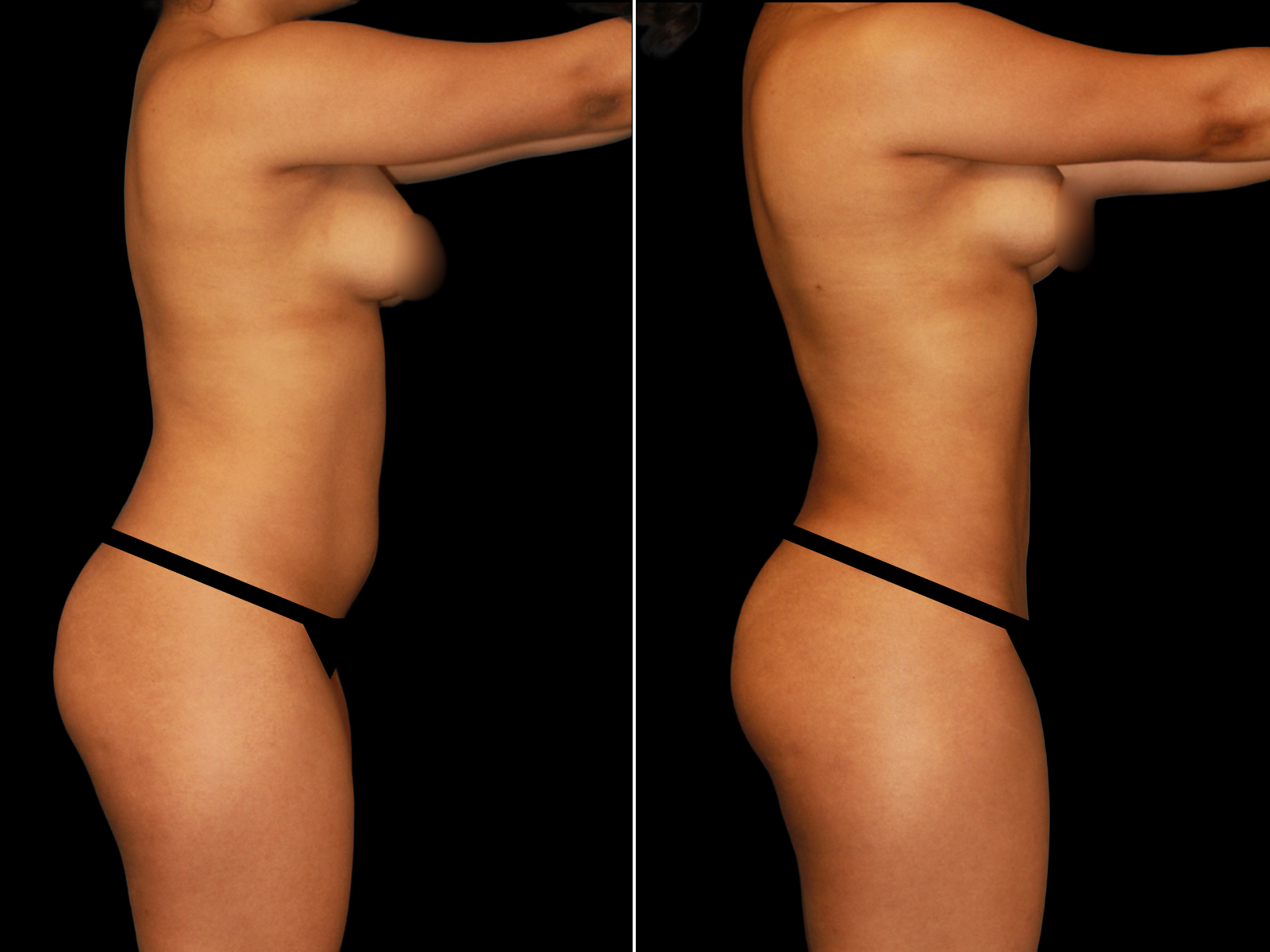 liposuction-before-and-after-dr-soler-baillo-coral-gables-02