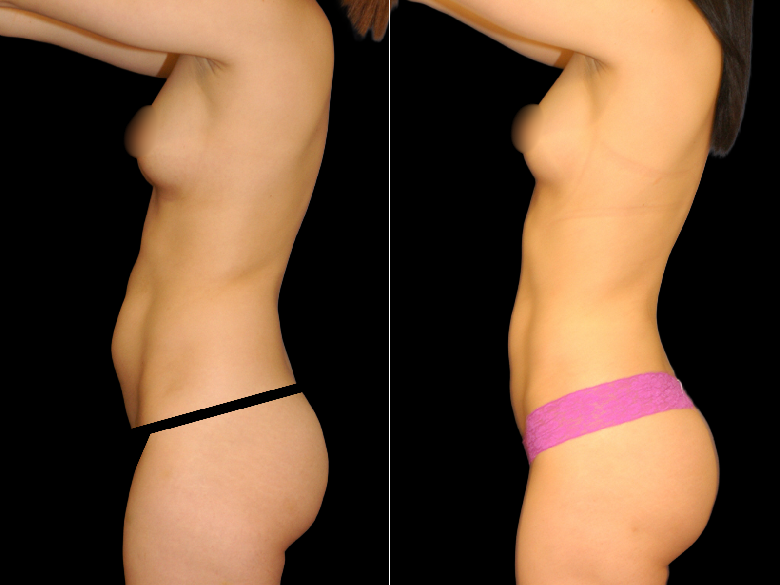 liposuction-before-and-after-dr-soler-baillo-coral-gables-03