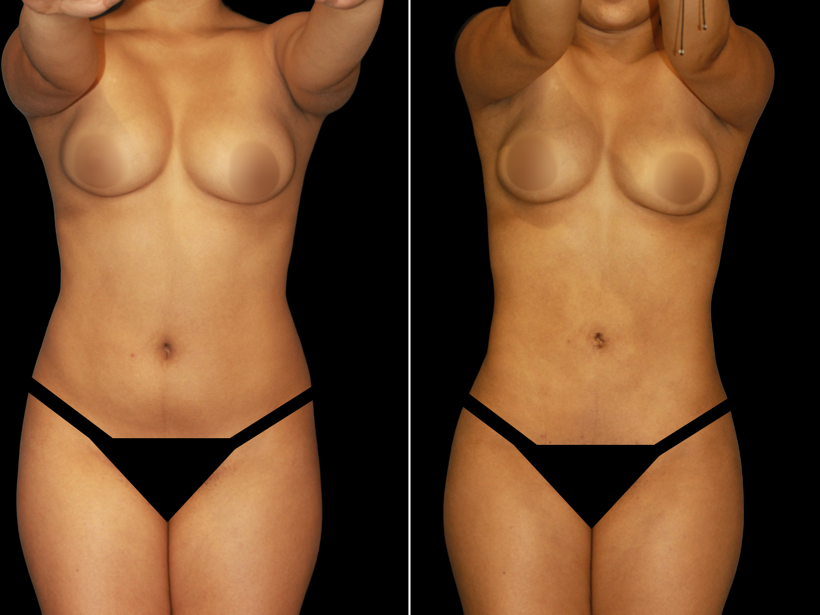 liposuction-before-and-after-dr-soler-baillo-coral-gables-05