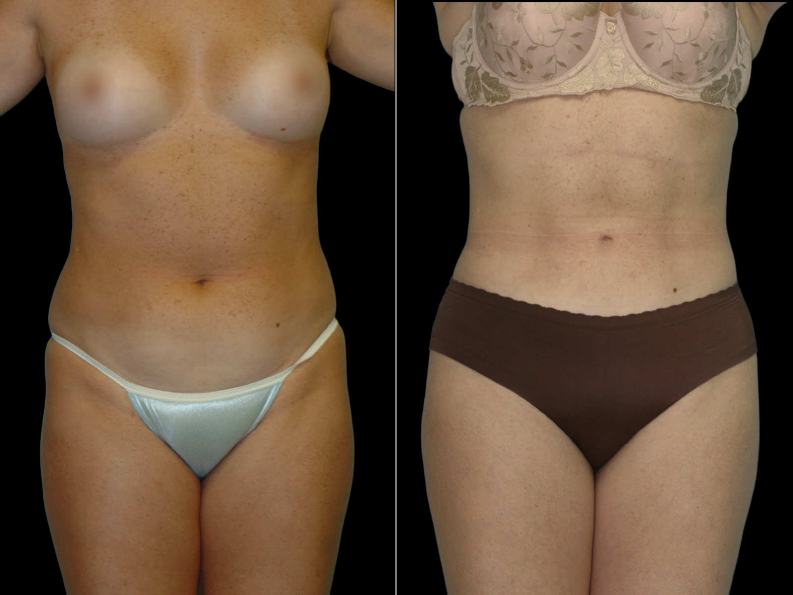 liposuction-before-and-after-dr-soler-baillo-coral-gables-09