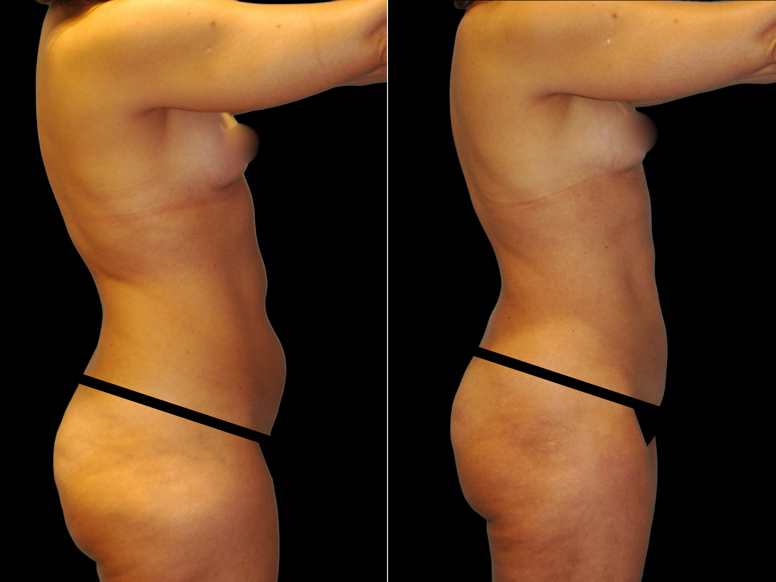 liposuction-before-and-after-dr-soler-baillo-coral-gables-10