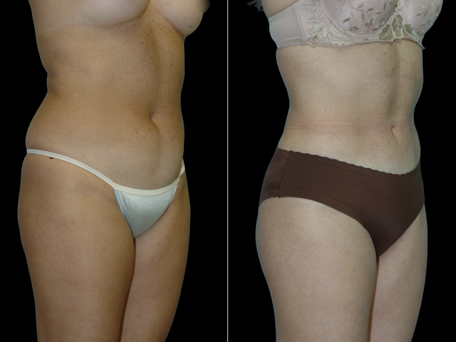 liposuction-before-and-after-dr-soler-baillo-coral-gables-11