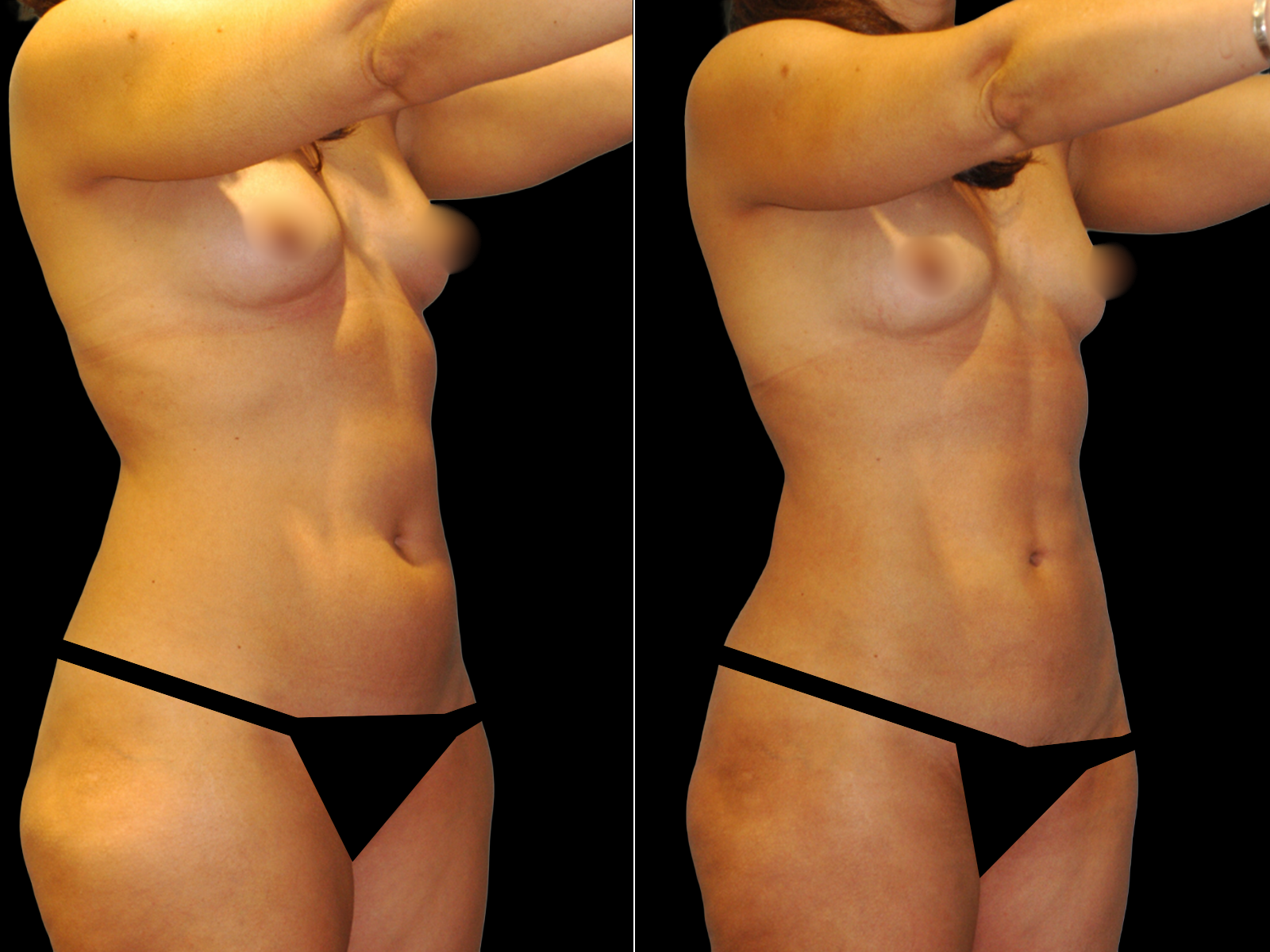 liposuction-before-and-after-dr-soler-baillo-coral-gables-12