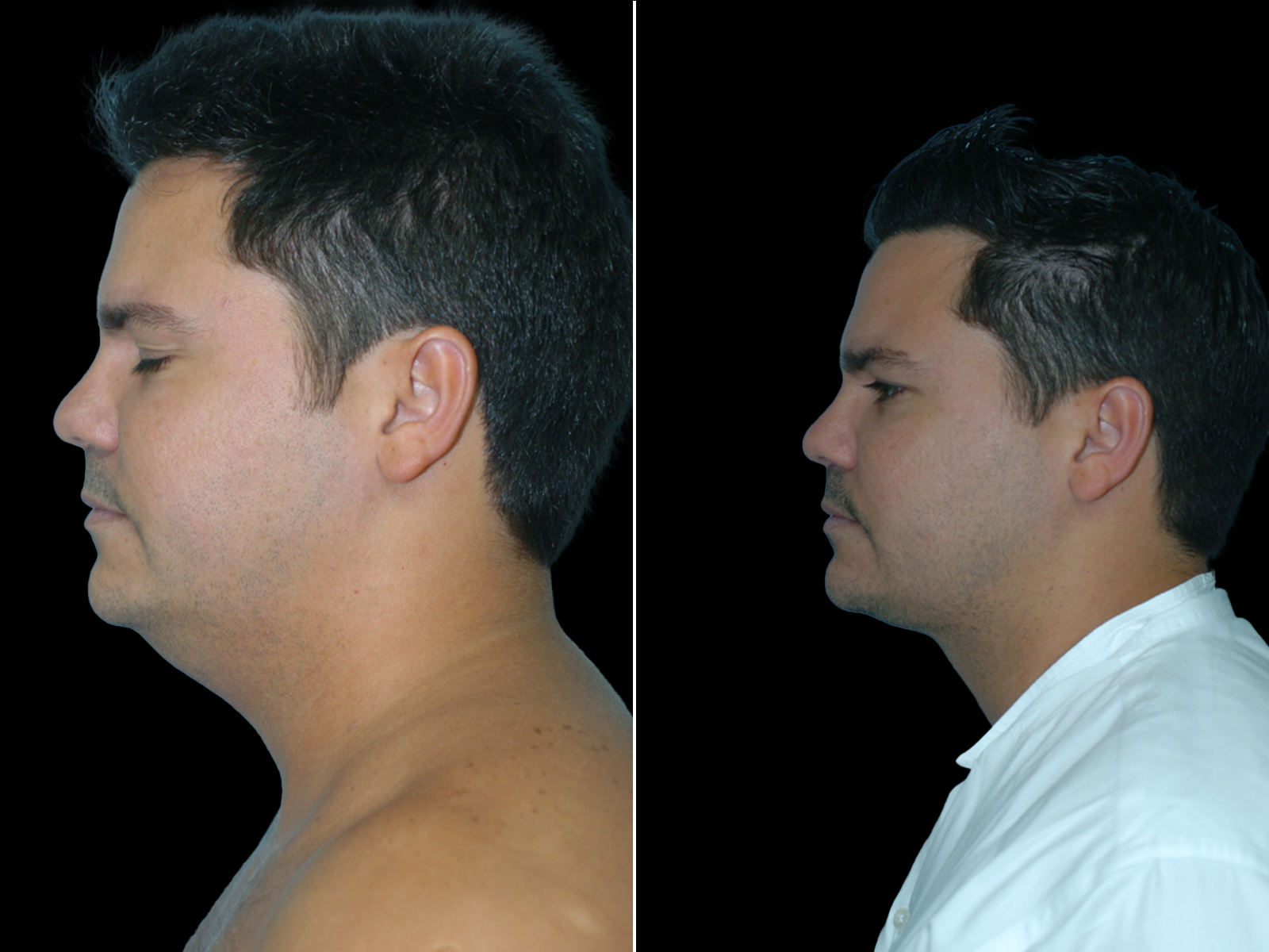 the-angle-before-and-after-dr-soler-baillo-coral-gables-01