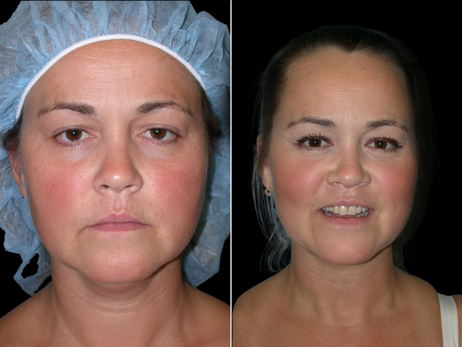 the-angle-before-and-after-dr-soler-baillo-coral-gables-02
