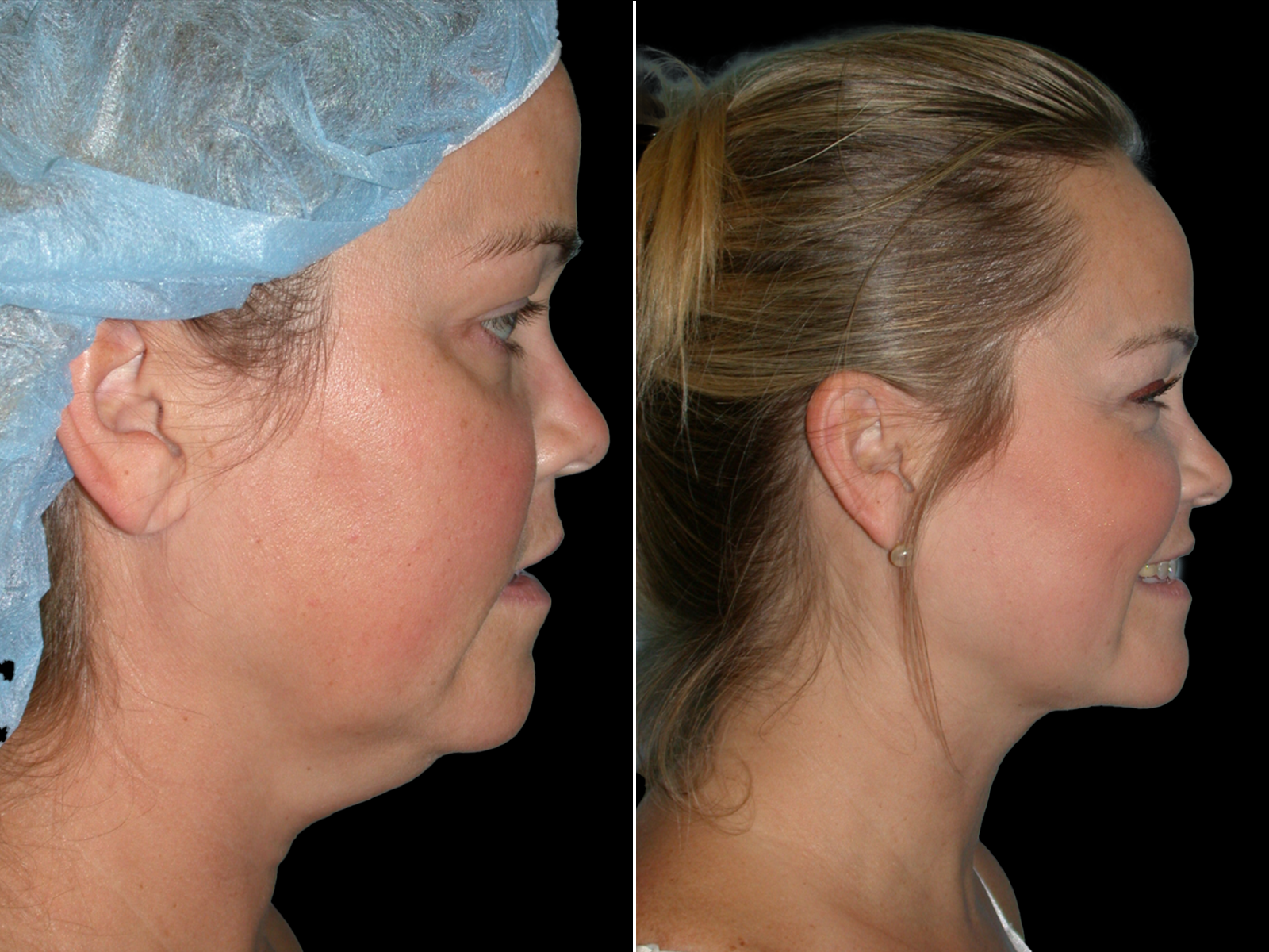 the-angle-before-and-after-dr-soler-baillo-coral-gables-03