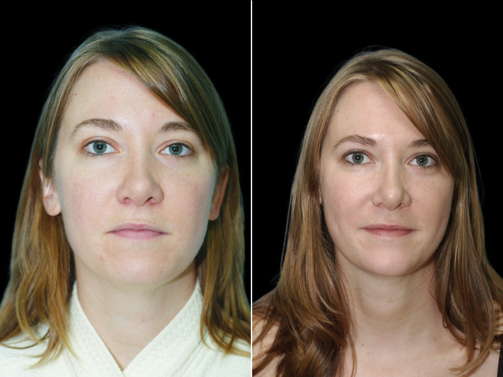 the-angle-before-and-after-dr-soler-baillo-coral-gables-04