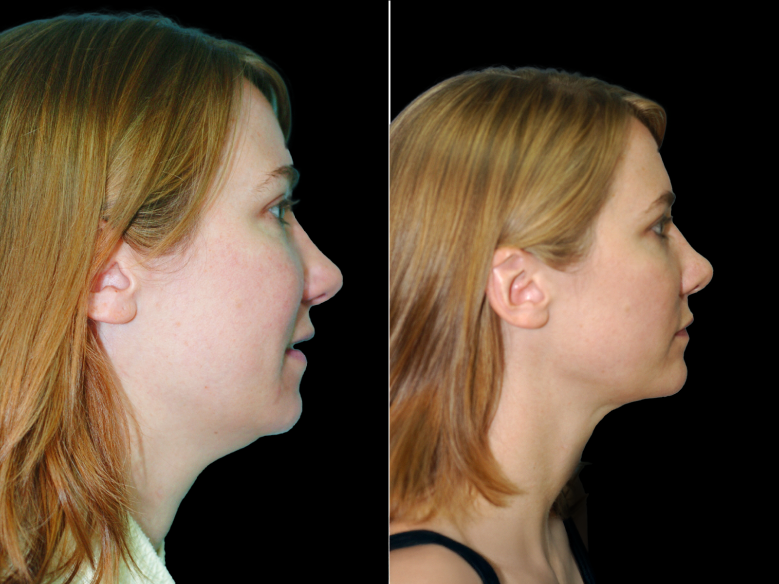 the-angle-before-and-after-dr-soler-baillo-coral-gables-05