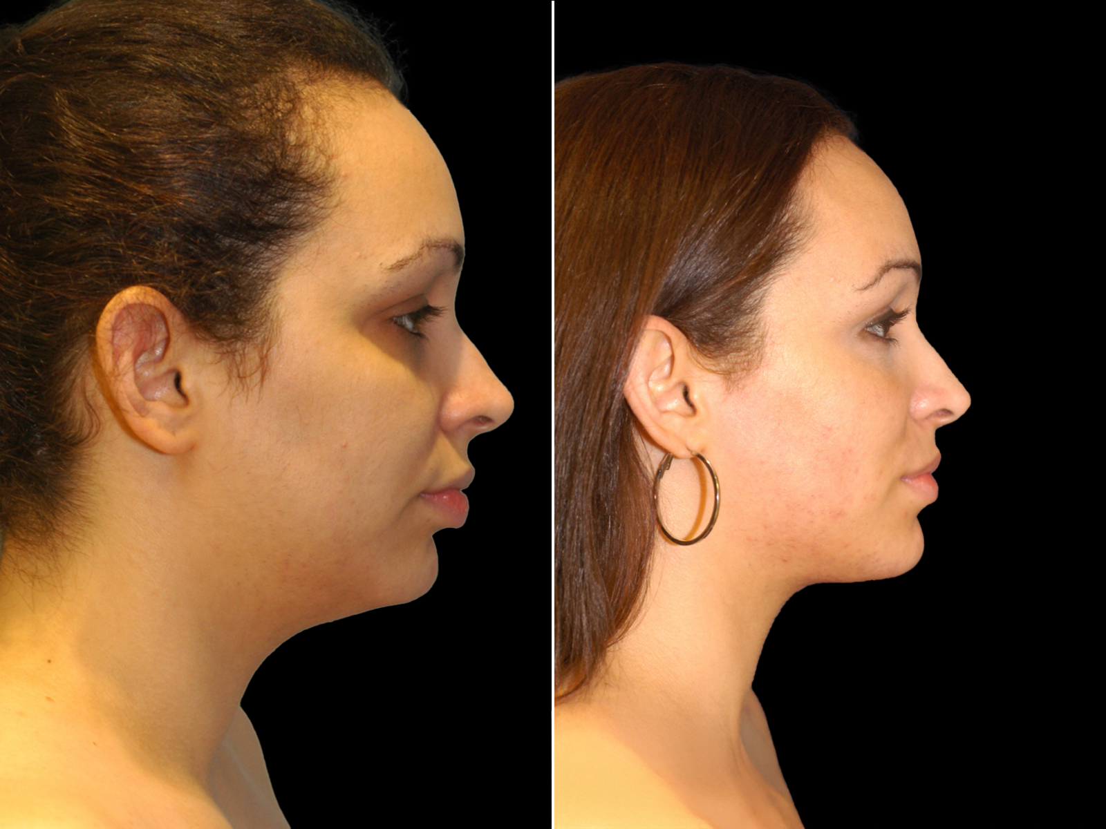 the-angle-before-and-after-dr-soler-baillo-coral-gables-08