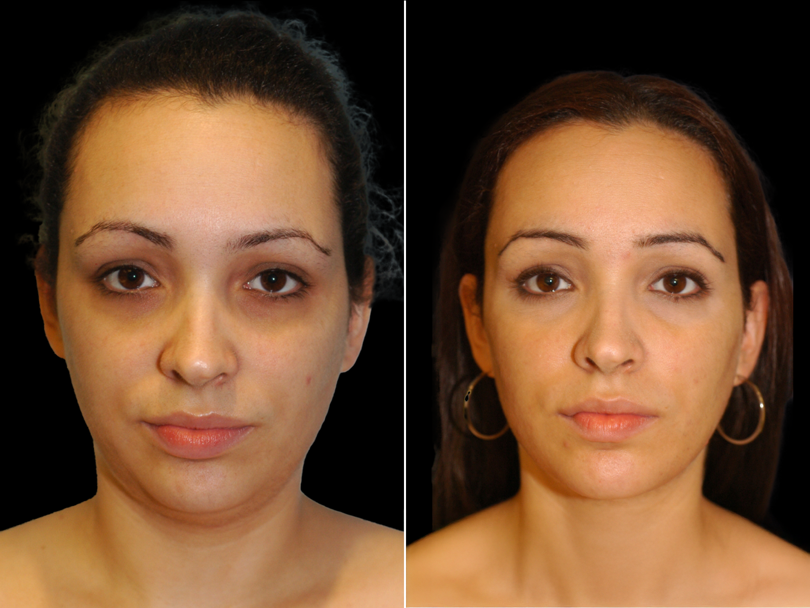 the-angle-before-and-after-dr-soler-baillo-coral-gables-09