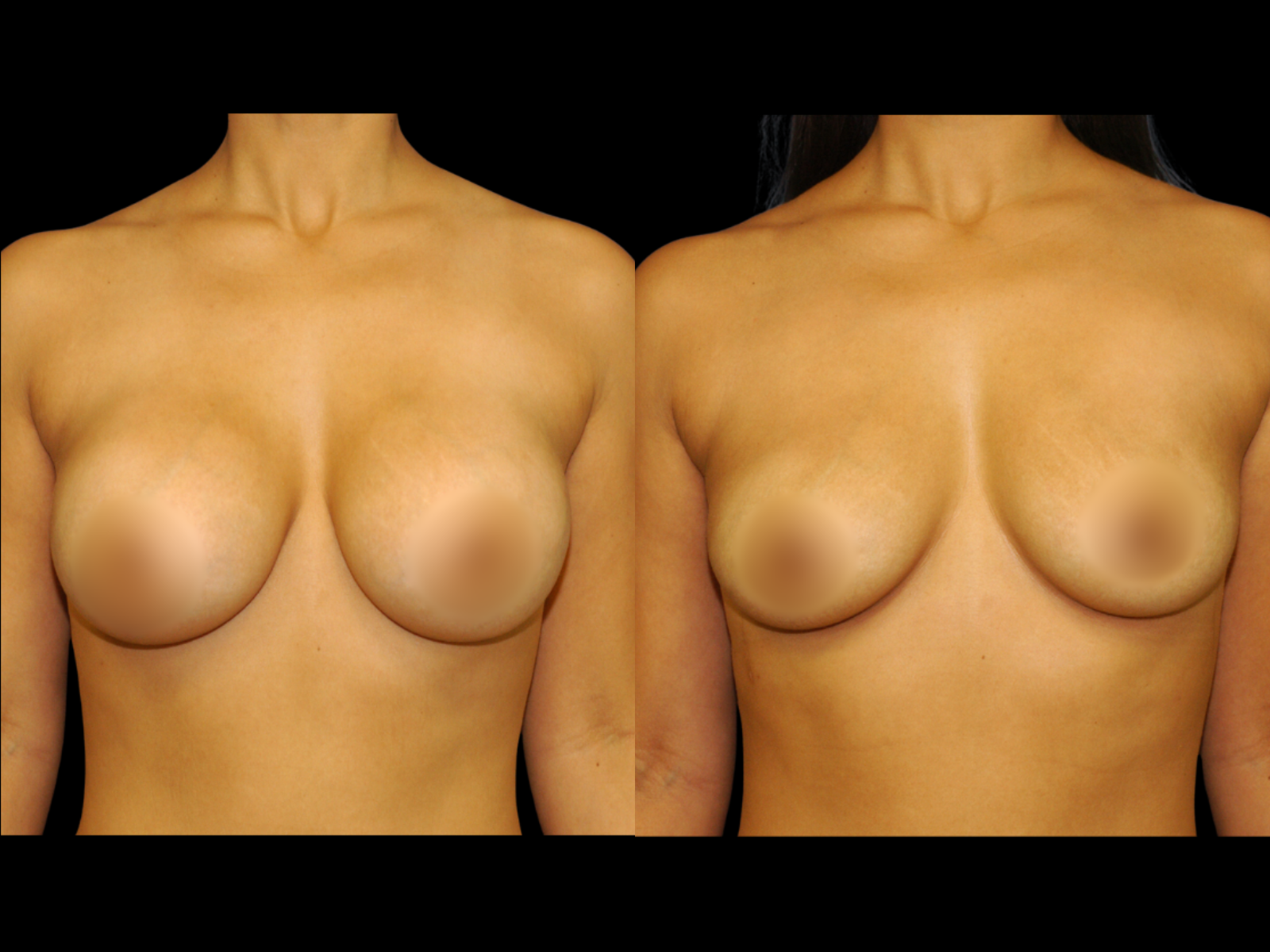 This patient underwent a customized implant removal surgery with a periareolar approach.