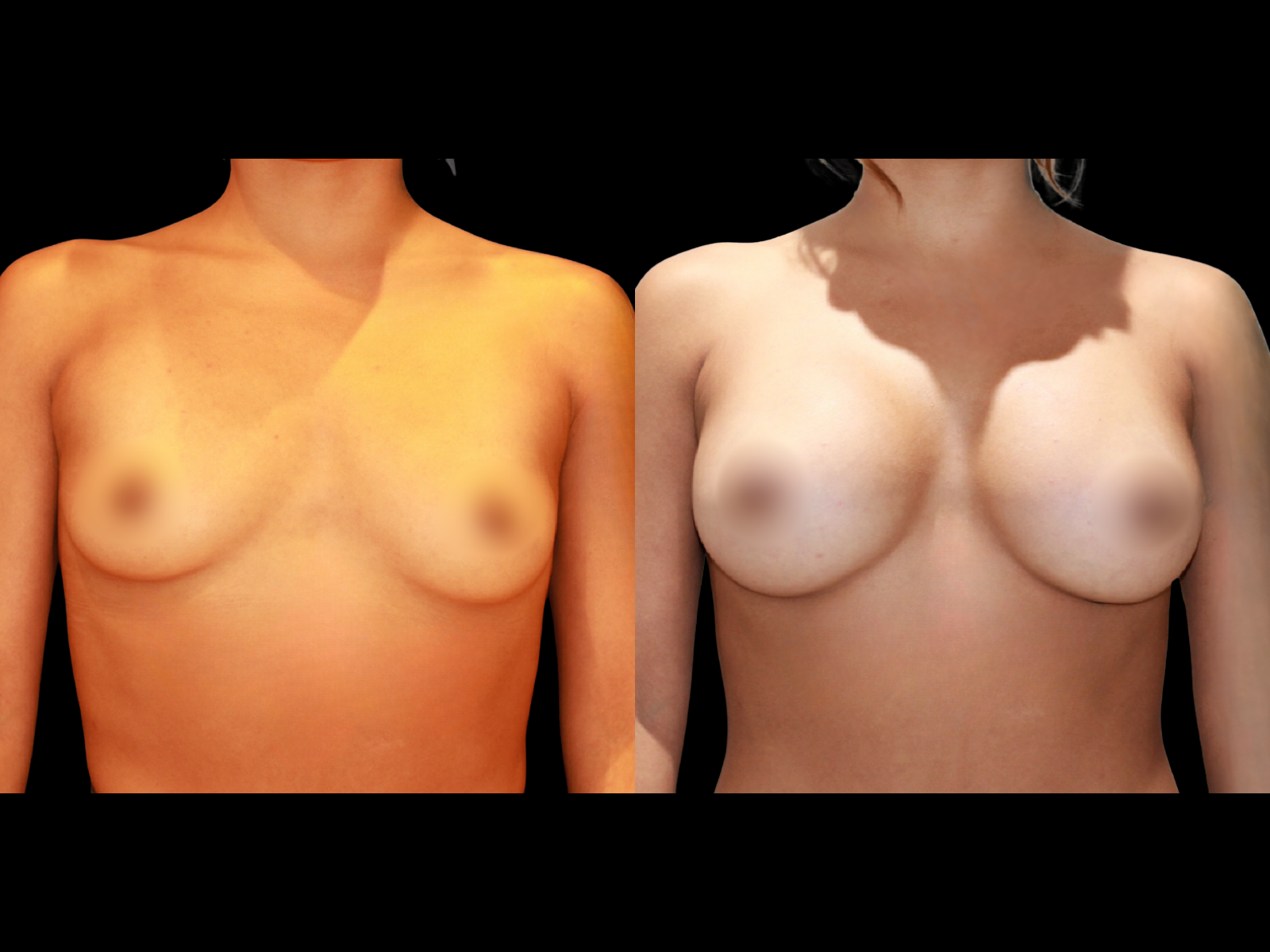 breast-aug-before-and-after-coral-gables-12 (1)