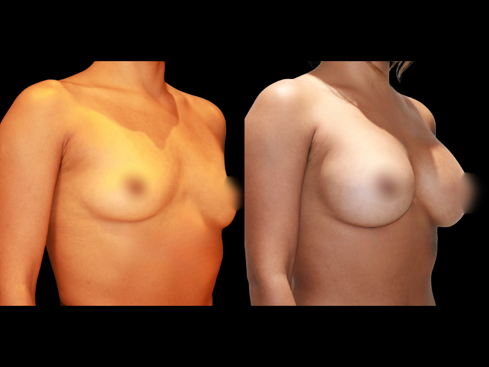 breast-aug-before-and-after-coral-gables-12