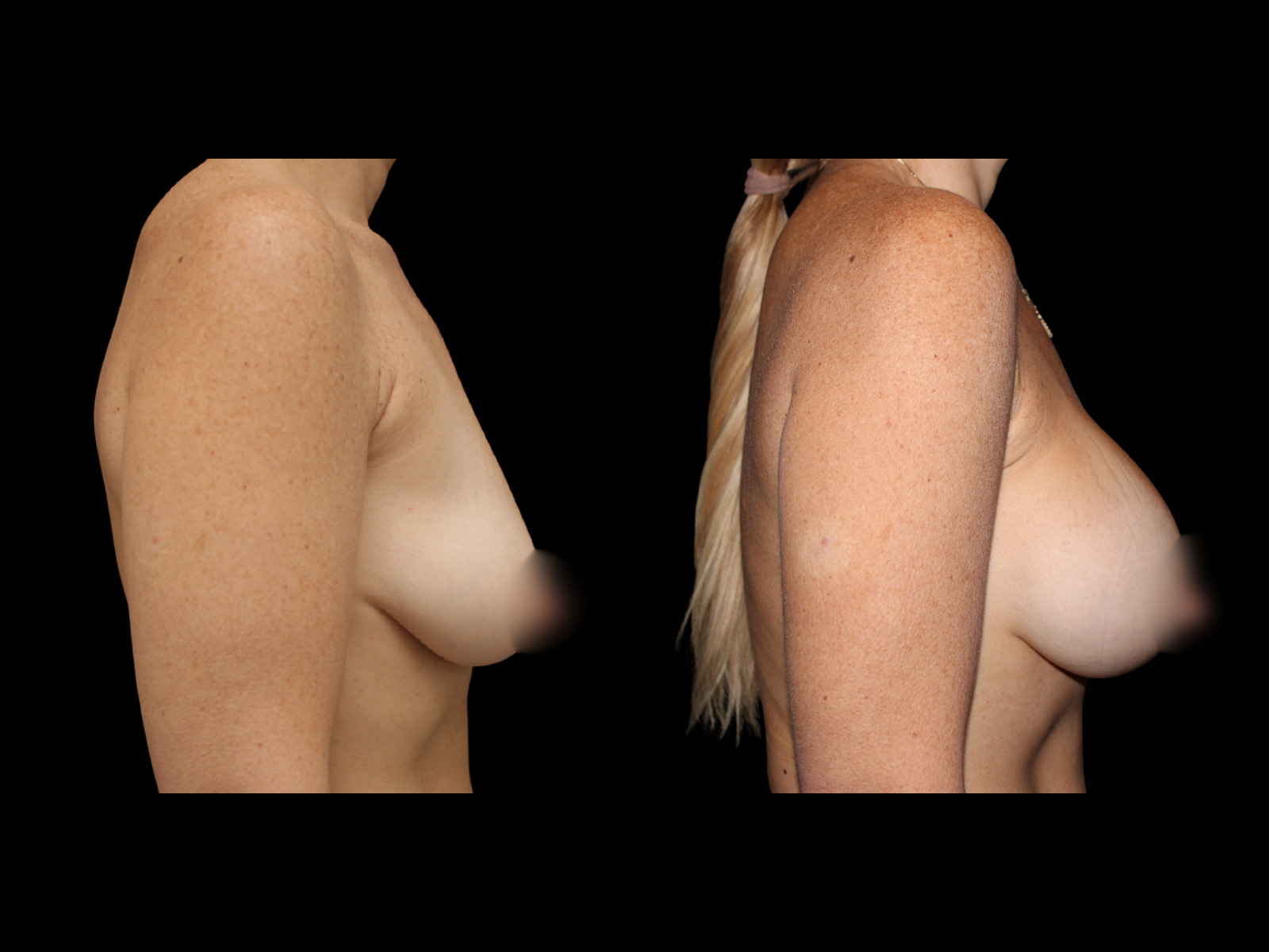 breast-aug-before-and-after-coral-gables