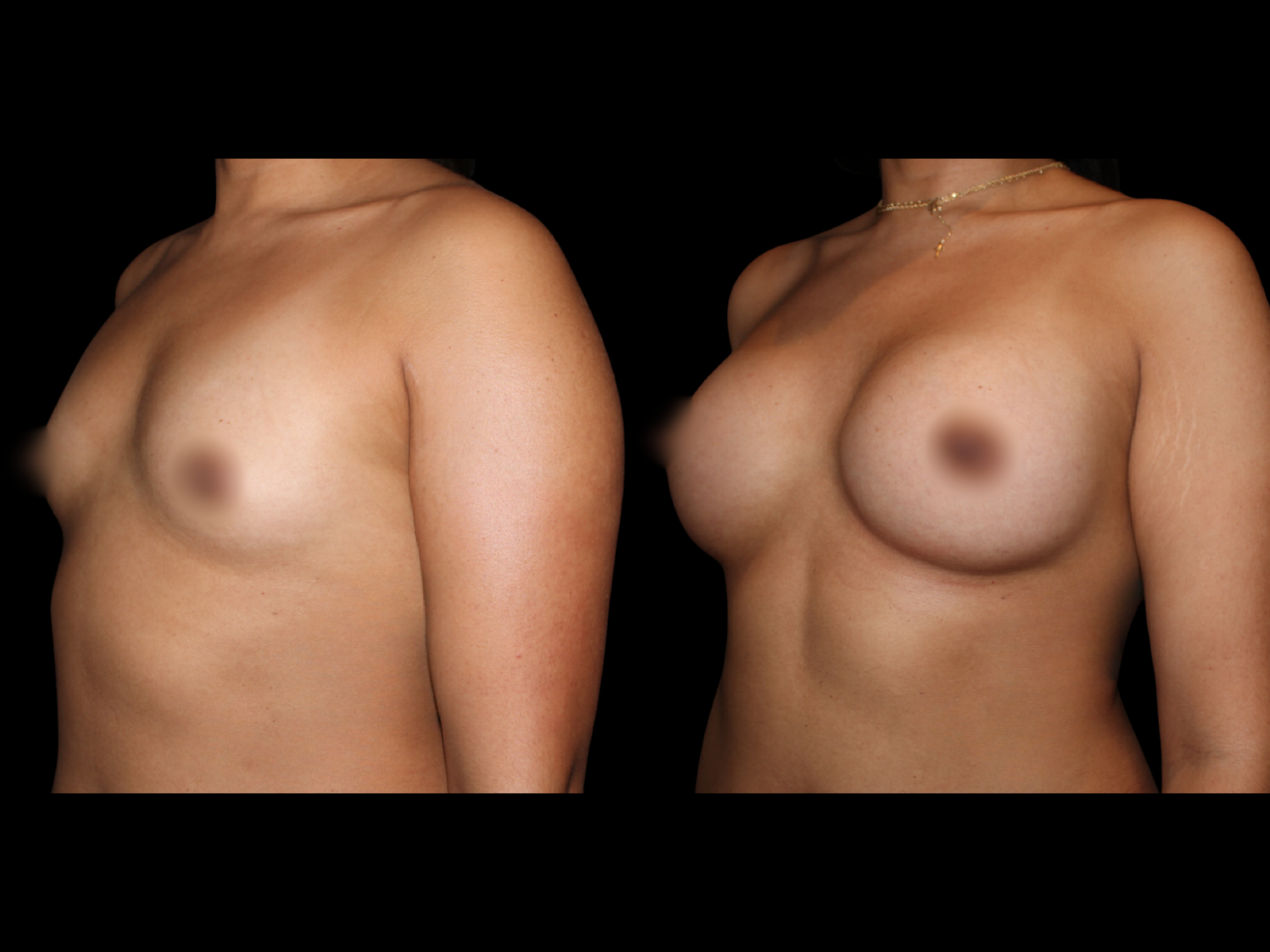 breast-aug-before-and-after-miami (1)