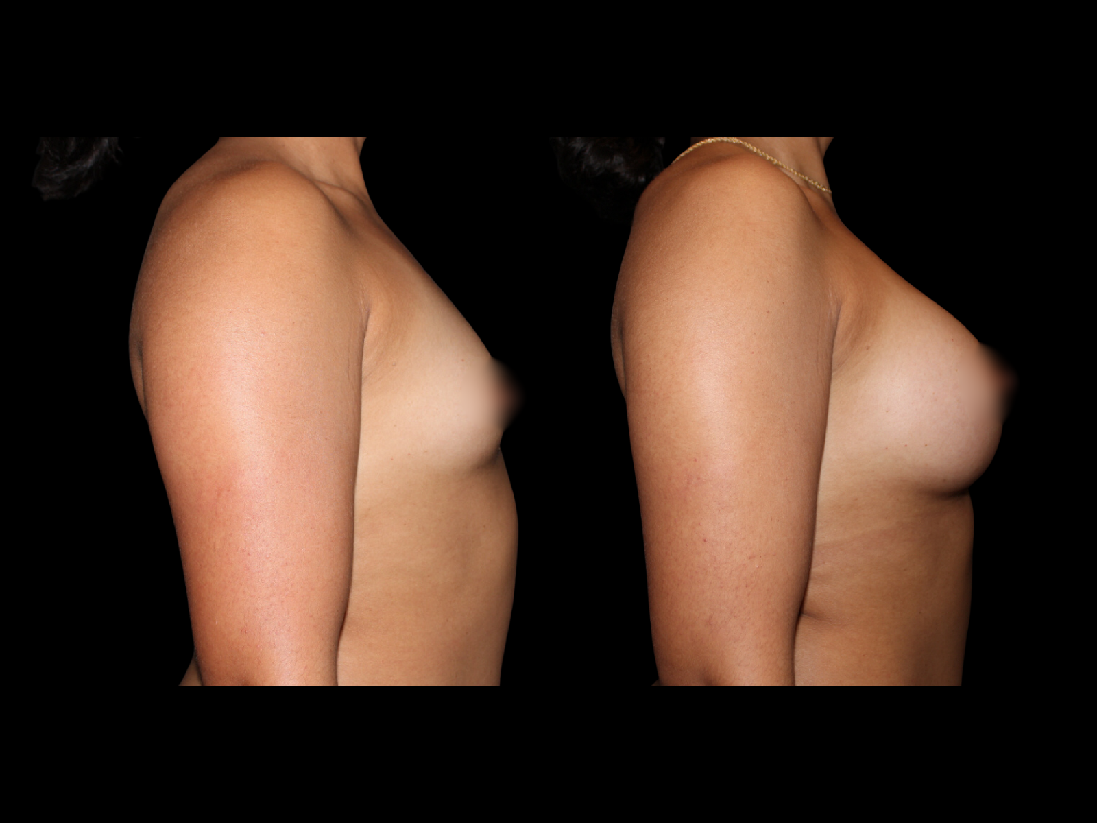 breast-aug-before-and-after-miami