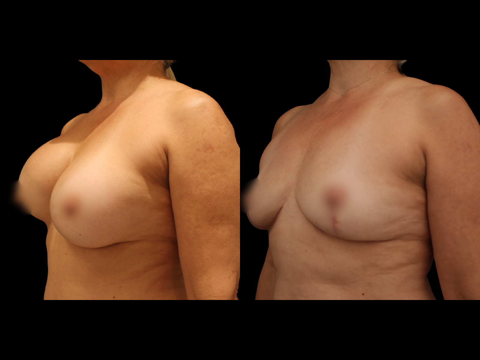 breast-explantation-before-and-after-coral-gables (1)