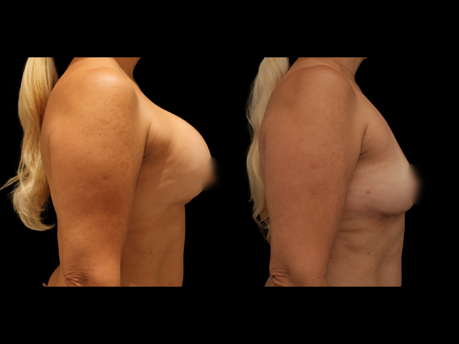 breast-explantation-before-and-after-coral-gables