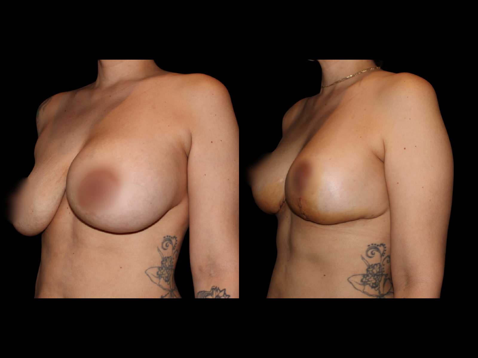 breast-explantation-before-and-after-miami (1)