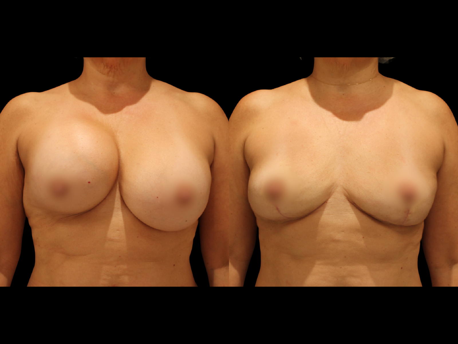 breast-explantation-before-and-after-miami