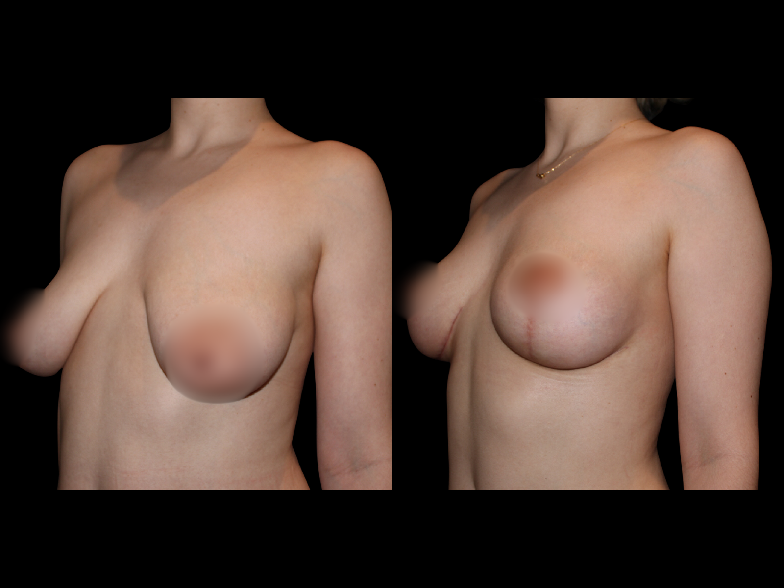 Scars were photographed 1 week post-op.