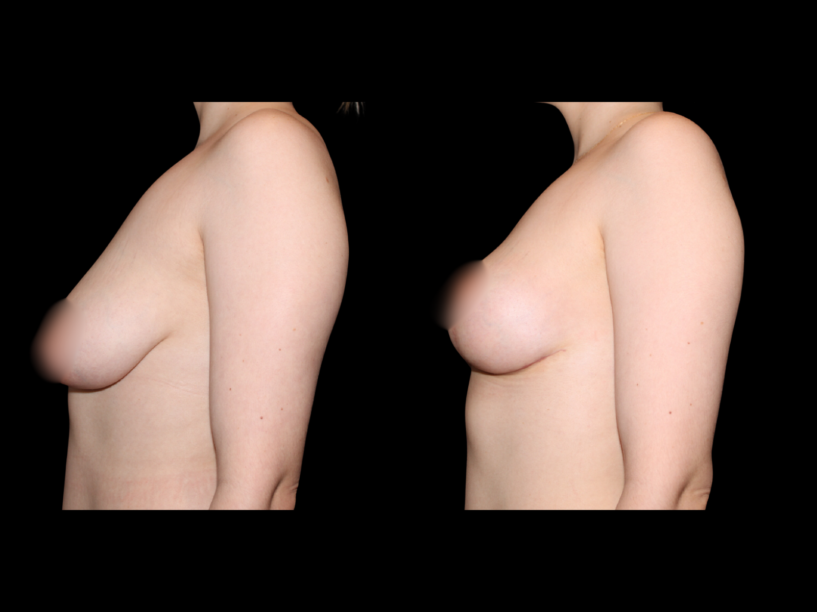 Scars were photographed 1 week post-op.