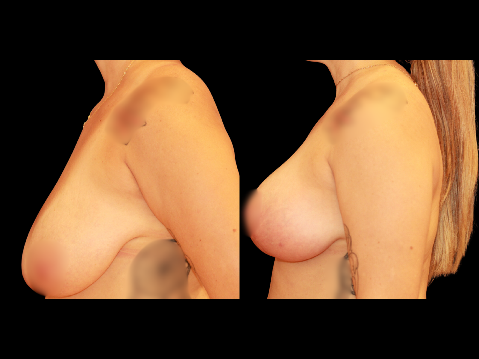 breast-reduction-before-and-after-miami (1)