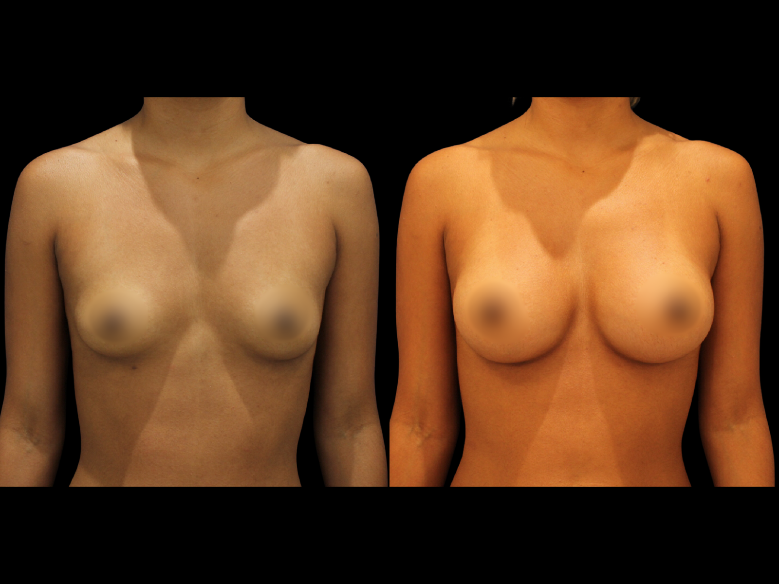 dr-soler-baillo-breast-augmentation-before-and-after-11 (1)