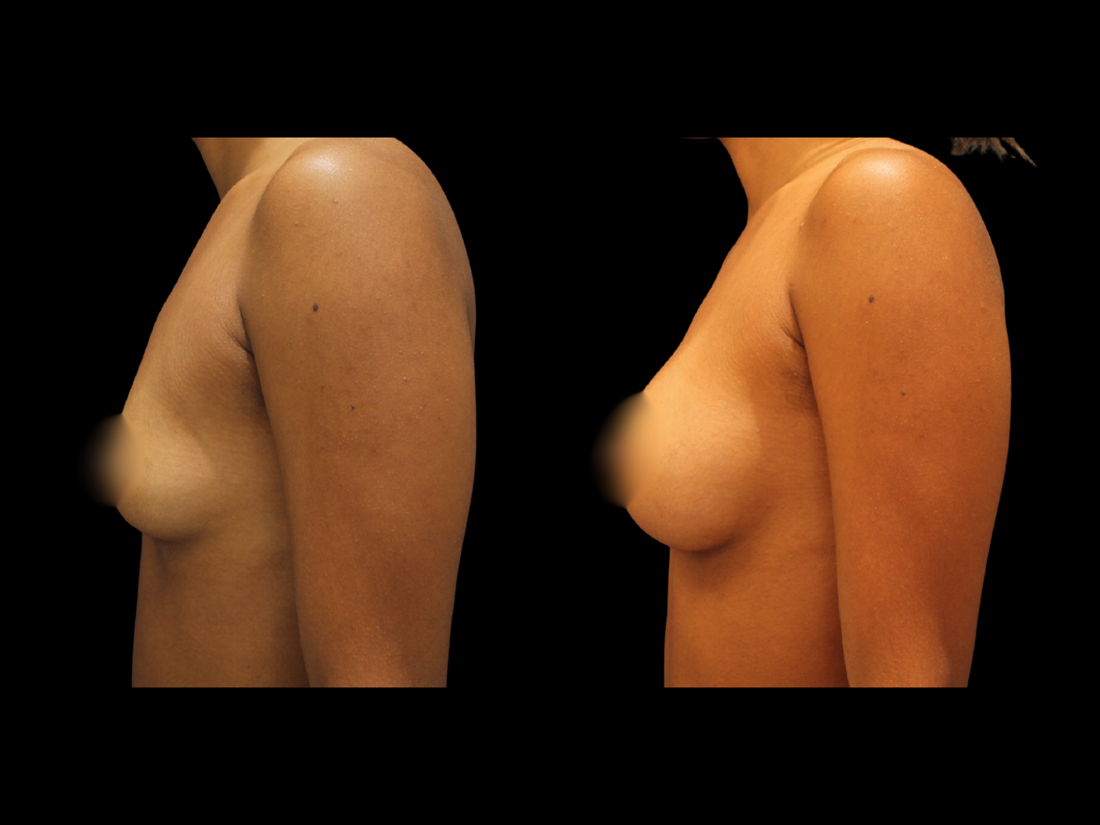dr-soler-baillo-breast-augmentation-before-and-after-11