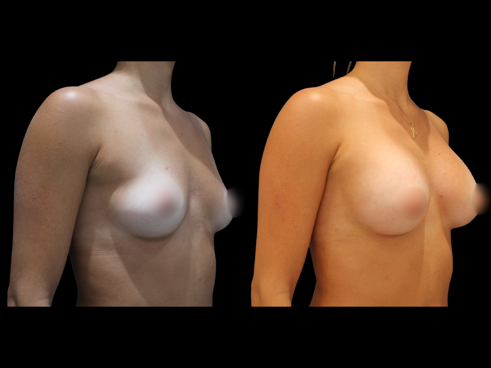 dr-soler-baillo-breast-augmentation-before-and-after-14 (1)