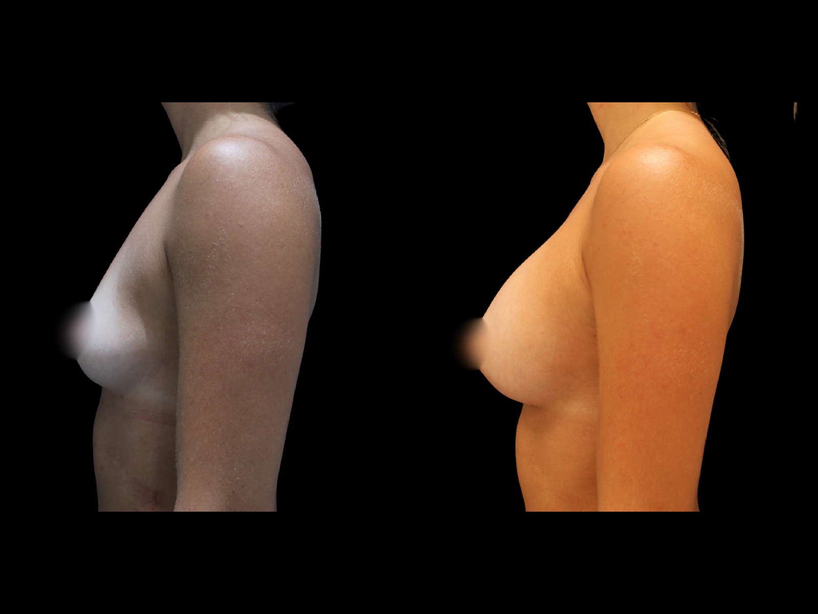 dr-soler-baillo-breast-augmentation-before-and-after-14