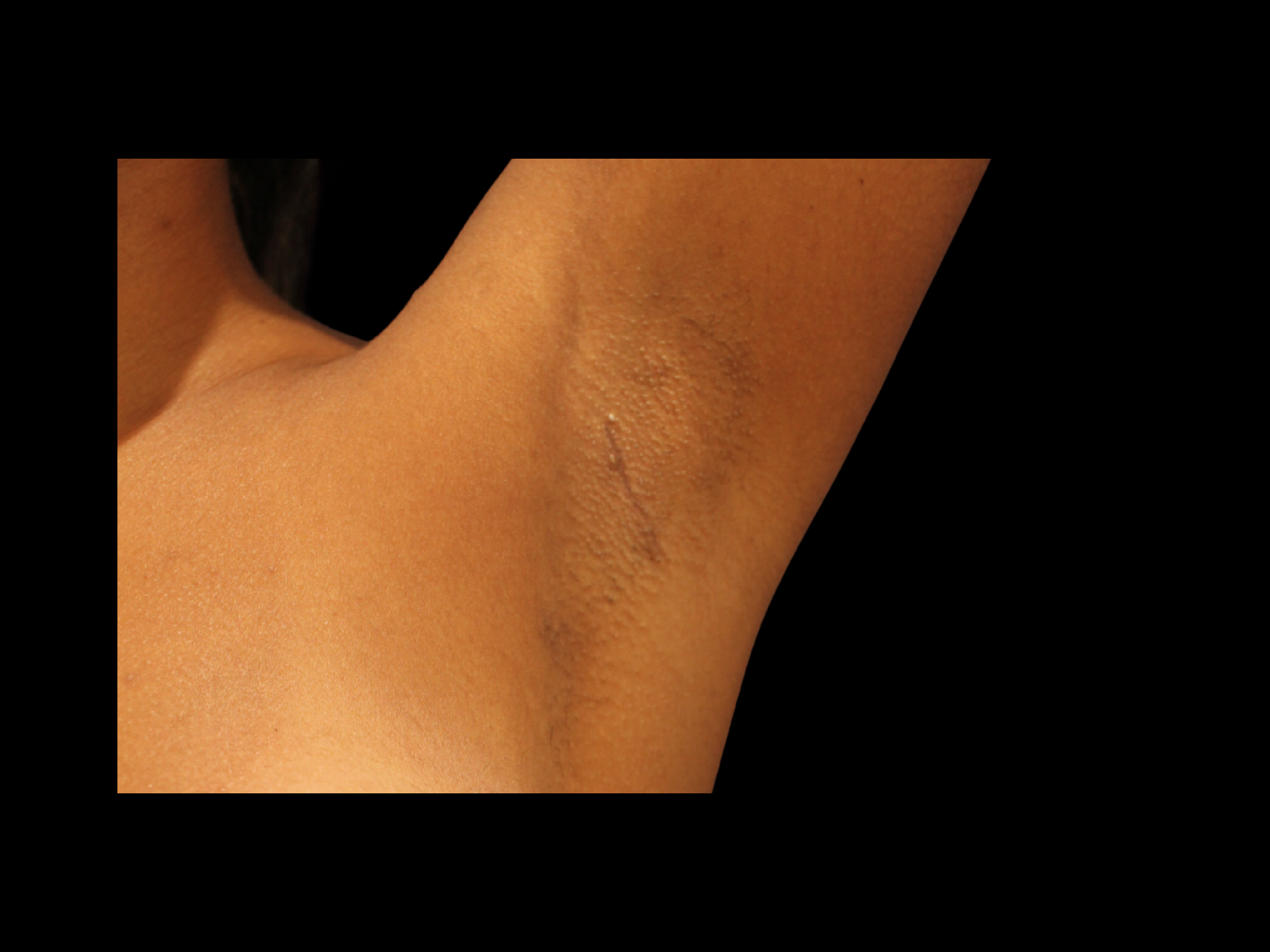 dr-soler-baillo-breast-augmentation-before-and-after-scar11